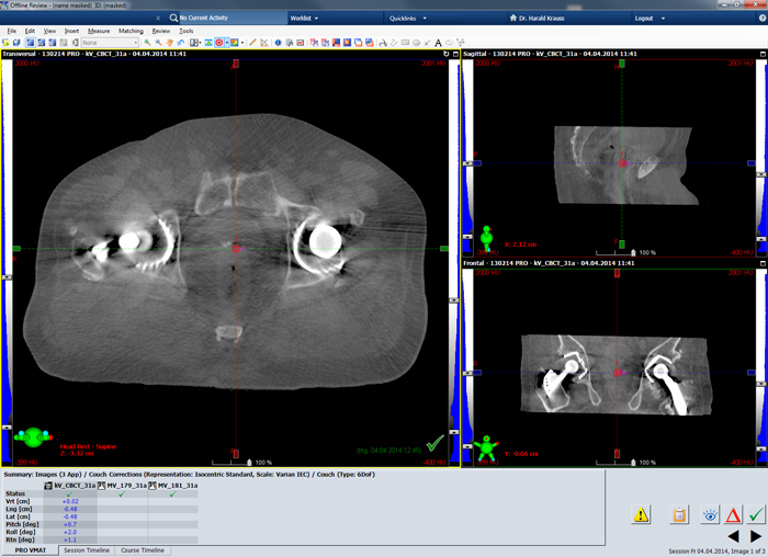 CBCT, double hip prothesis