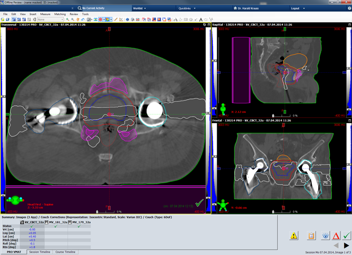 Planning CT showing isocenter planes of session 32 with Structures used for dose planning.