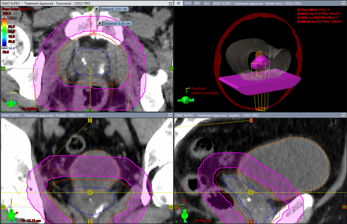 NS_Control ring structure to avoid hotspots near the prostate PTV