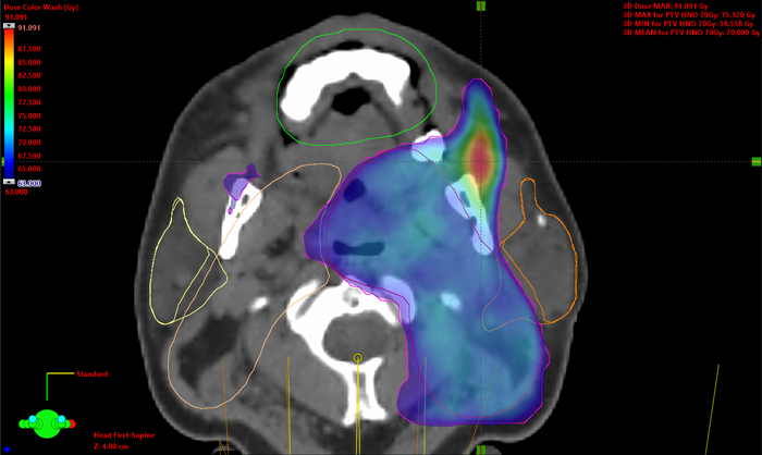 Hotspot at typical location during head and neck VMAT