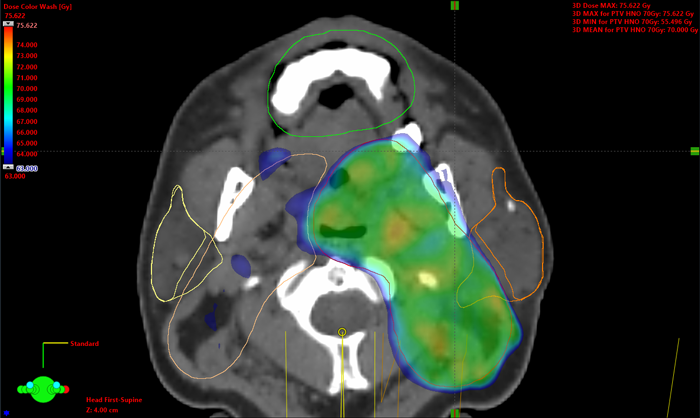 Hotspot at typical location during head and neck VMAT removed